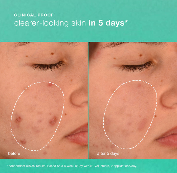 breakout biotic moisturizer