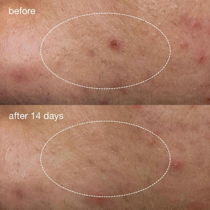 deep breakout invisible liquid patch - Dermalogica Singapore