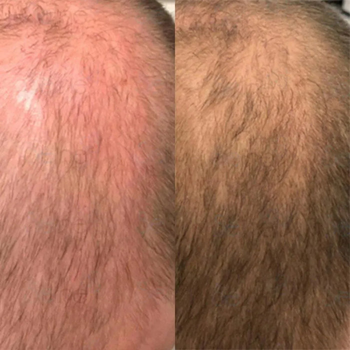 Panthrix hair growth serum 3-pack (Redensyl) - Hairgivers