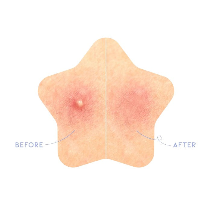 STAR SPOT PATCH 80 PATCHES – Plasturi Hidrocoloizi Pentru Acnee Cu Niacinamida Si Ceramide